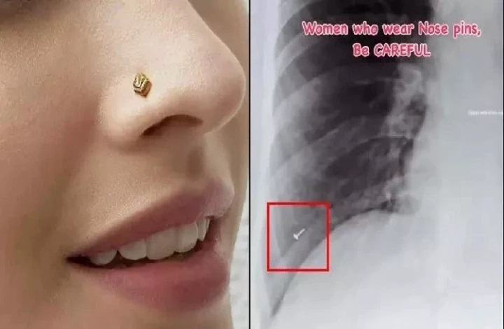 అలర్ట్: శ్వాస పీల్చుకుంటుండగా మహిళ ఊపిరితిత్తుల్లోకి జారిన ‘ముక్కుపుడక’ : ఎక్స్-రే చూసి డాక్టర్లే షాక్!