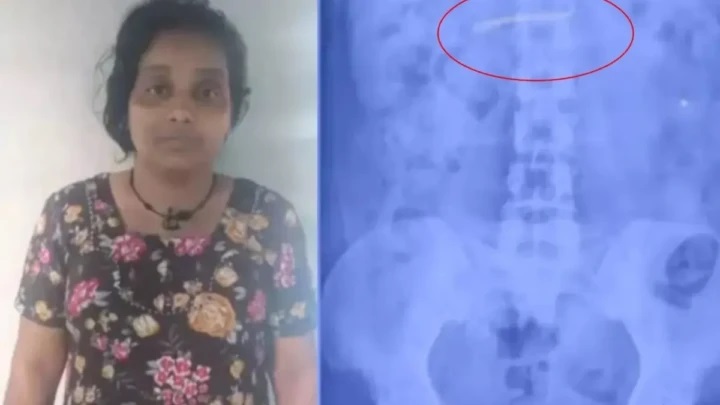 బంగారం ధరలు ఆకాశాన్నంటుతున్న వేళ.. మహిళ కడుపులో ఎక్స్‌రేలో కనిపించిన అద్భుతం.. అసలైన ట్విస్ట్ అక్కడే ఉంది!