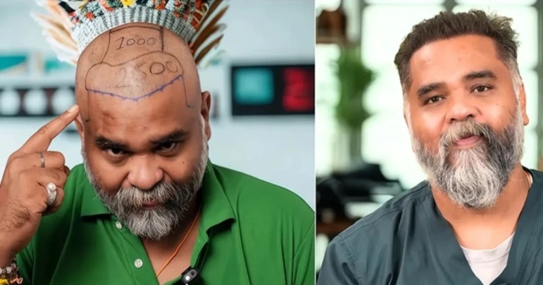 జుట్టు మార్పిడి శస్త్రచికిత్స.. చెన్నైలో బయటపడిన భయంకరమైన నిజం.. సంచలన సమాచారం!