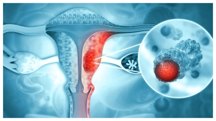 మహిళల్లో అండాశయ క్యాన్సర్: ఈ 7 లక్షణాలు కనిపిస్తే అస్సలు నిర్లక్ష్యం చేయకండి!