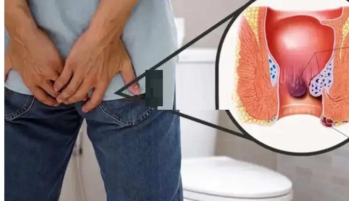 ఆపరేషన్ లేకుండానే ఇంట్లోనే మొలల (Piles) సమస్యకు చెక్: వంకాయతో కొన్ని చిట్కాలు