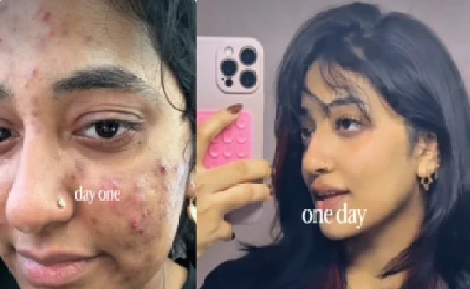 ముఖం నిండా మొటిమలు, ప్రతిరోజూ తల్లి వద్ద ఏడ్చిన కూతురు; కేవలం ₹10లతో దొరికిన పరిష్కారం!