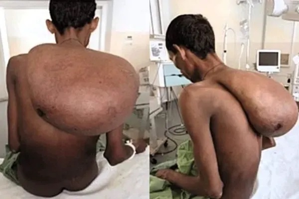 మొదట నిమ్మకాయలాగే ఉంది..! కానీ అకస్మాత్తుగా 25 కిలోల కొండలా మారింది. రైతు జీవితాన్ని మలుపు తిప్పిన కణితి.. వైద్య ప్రపంచంలో వింత..!!