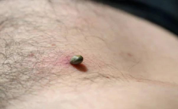 Warts Removal: శరీరంలోని పులిపుర్లు పోగొట్టడానికి 5 అద్భుతమైన ఇంటి చిట్కాలు!