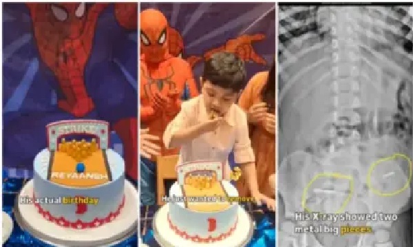 హ్యాపీ బర్త్డే టూ భయంకరం.! కేక్ డెకరేషన్ కోసం ఇనుప మేకులా..? “ఆశగా తిన్న చిన్నారి కడుపులో ఇనుప చువ్వలు”.. స్కాన్లో తేలిన షాకింగ్ నిజం.. దడ పుట్టించే వీడియో.!!!