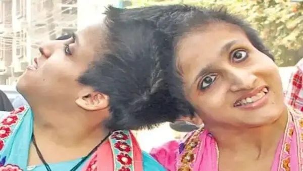 తలలు అతుక్కుని పుట్టిన కవలలు! ‘సుప్రీంకోర్టు ఆదేశించినా మందులివ్వట్లేదు’.. 23 ఏళ్లుగా ఒకే గదిలో బందీలైన సోదరీమణులు! అన్న కన్నీళ్లకు అధికారుల నిర్లక్ష్య సమాధానం!