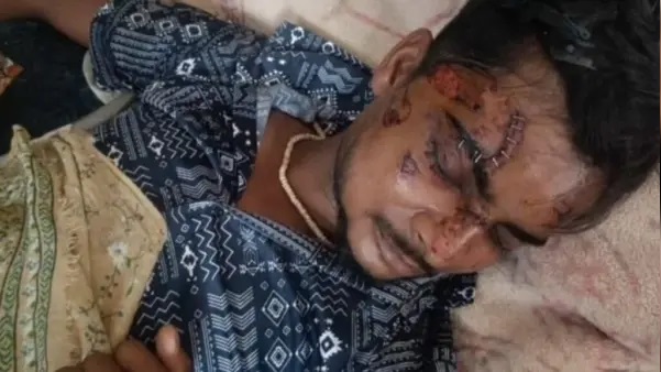 “ముఖమంతా స్టేప్లర్ పిన్నులే!” మోటోరోలా ఫోన్ పేలి చెల్లాచెదురవడంతో విలవిల్లాడిన యువకుడు.. అలీగఢ్‌లో జరిగిన ఘోర ప్రమాదంతో హడలిపోయిన జనం..!!”