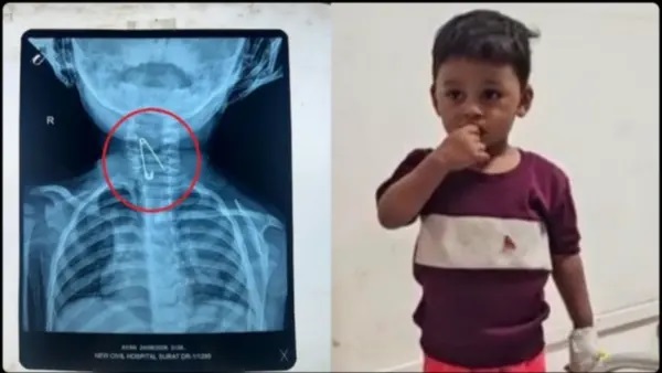 30 నిమిషాల పోరాటం..! ఏడాదిన్నర చిన్నారి ఆహారవాహికలో చిక్కుకున్న పిన్.. ఎక్స్రే చూసి షాకైన వైద్యులు.. ఆ తర్వాత జరిగిన ఊపిరి పీల్చుకునే ఘటన..!!