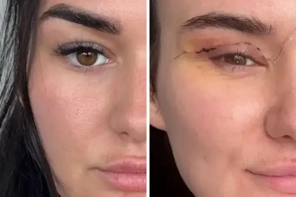 “నిద్రపోయేటప్పుడు కళ్లు మూతపడటం లేదు.. టేప్ వేసి అంటించుకుంటున్నా!” — చౌక ప్లాస్టిక్ సర్జరీ తెచ్చిన ముప్పు.. విదేశాలకు వెళ్లిన మహిళలకు ఊహించని షాక్.. అందం కోసం వెళ్తే ప్రాణాల మీదకు వచ్చిన వైనం!