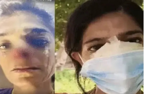“డబ్బులు ఇవ్వలేదని ముక్కు కొరికి నమిలేసిన దారుణం…!” ముక్కుపుడక లాక్కోవడానికి జరిగిన షాకింగ్ దాడి… కలకలం రేపిన సంఘటన…!!