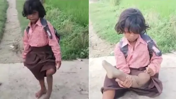 “నేనూ చదువుకోవాలి!”.. ఒంటికాలితో 400 మీటర్లు గెంతుతూ బడికి వెళ్తున్న 7 ఏళ్ల బాలిక.. కంటతడి పెట్టిస్తున్న హృదయ విదారక గాథ..!!!