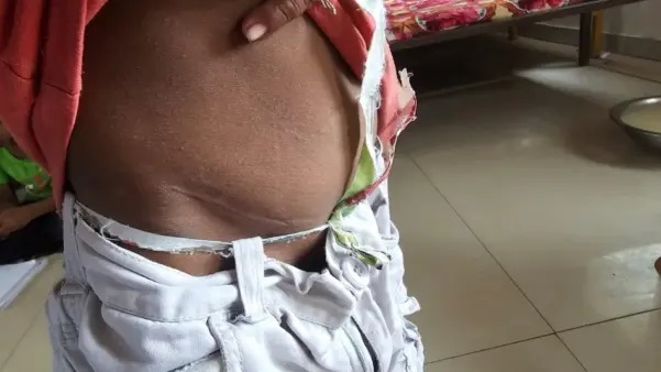 భిక్షాటన చేస్తున్న బాలురు..! కడుపుపై ఆందోళన కలిగించే గాయాలు. సంపాదించిన డబ్బు కూడా వారే తీసుకుంటారట. కిడ్నీలను కూడా వదల్లేదా? వెలుగులోకి వచ్చిన కొత్త కలకలం. విస్మయంలో అధికారులు..!